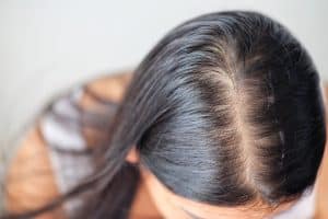Vous souffrez de la perte de cheveux ? Ces astuces peuvent vous aider